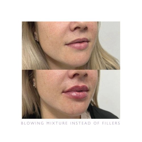 بديل الفيلر