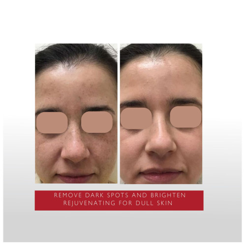 المقشر المركز 