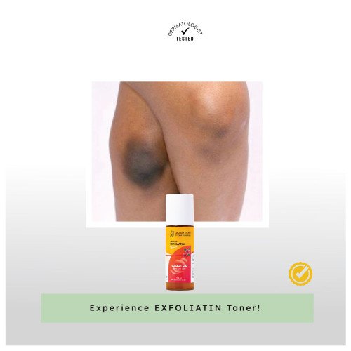 تونر التقشير 