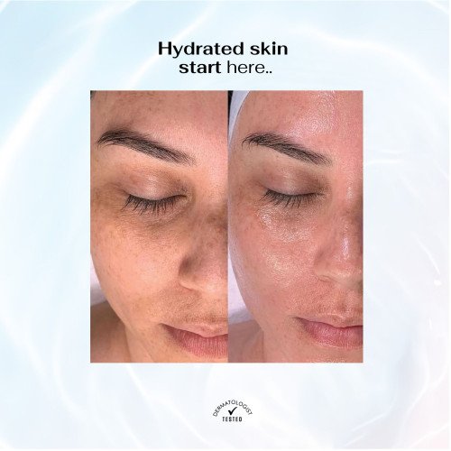 سيروم الهيالورونيك أسيد