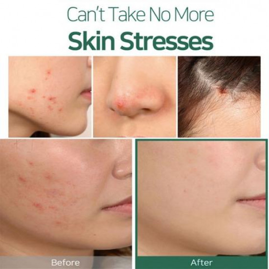 Some By Mi 30 Days Miracle Tea Tree Clear Spot Oil (10ml) Some By Mi 30 Days Miracle Tea Tree Clear Spot Oil (10ml)