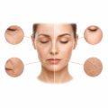 Wrinkles & Dry Skin