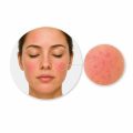 Skin inflammations