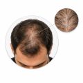 Hair Loss & Thinning