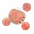Infectious & Irritated Skin Conditions