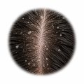 Scalp and dandruff